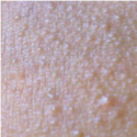 Adult with comedonian acne | Dermago