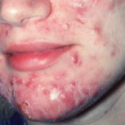 Adult with severe acne | Dermago