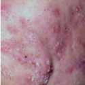 Adult with nodulo acne | Dermago