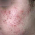 Adult with papulo acne | Dermago