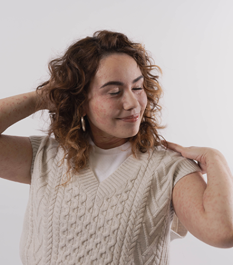 Happy woman with psoriasis on face and arms
