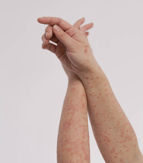 Psoriasis on hands and arms