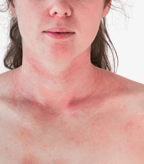 Woman with psoriasis on her neck