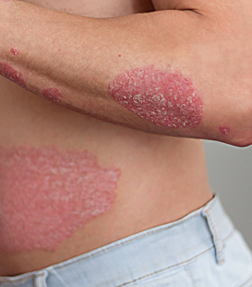Psoriasis on arms and belly