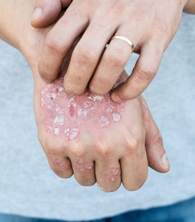 Psoriasis on person hands